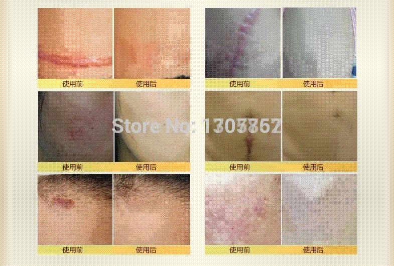 Duac akne gel rezeptfrei Apotheke