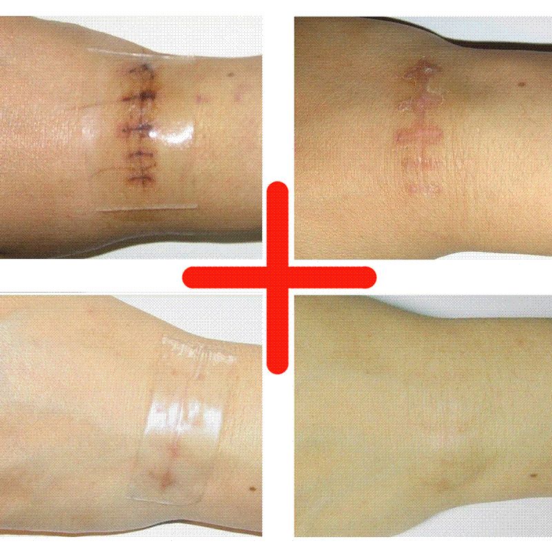 Silicone Patch Scar Removal Silicone Sheet To Remove Scar, Acne Scar