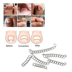 6Pcs Ingrown Toe Nail Correction Wire Fixer Pedicure Treatment Paronychia Recover Toenail Corrector Foot Care Tool