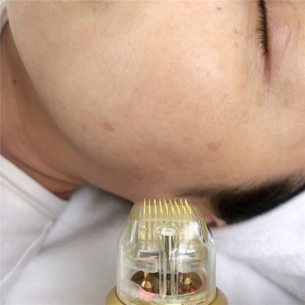 profeinal microneedle fractional rf wrinkle removal radio frequency machine for stretch marks face lifting
profeinal microneedle fractional rf wrinkle removal radio frequency machine for stretch marks face lifting