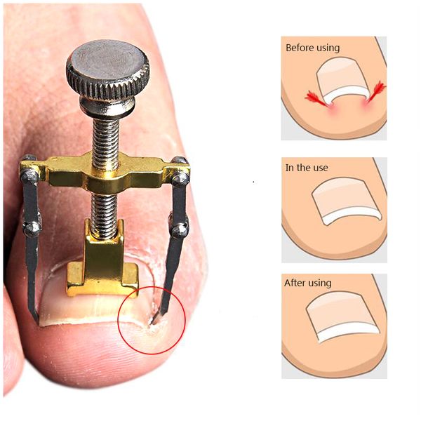 1pc stainless steel ingrown toe nail correction tool orthodontic device of embedded foot nail products set
1pc stainless steel ingrown toe nail correction tool orthodontic device of embedded foot nail products set