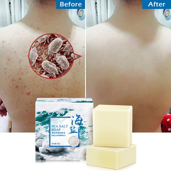 100g removal pimple pore acne treatment sea salt soap cleaner moisturizing goat milk soap face care wash basis soap tslm1
100g removal pimple pore acne treatment sea salt soap cleaner moisturizing goat milk soap face care wash basis soap tslm1