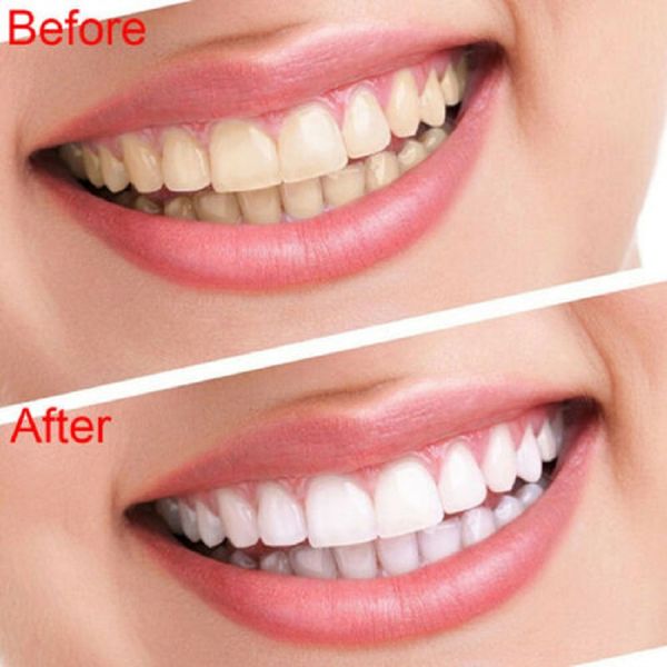 portable deskdental teeth whitening machine with 8 cold led light lamp bleaching accelerator kit on chair for clinic use
portable deskdental teeth whitening machine with 8 cold led light lamp bleaching accelerator kit on chair for clinic use