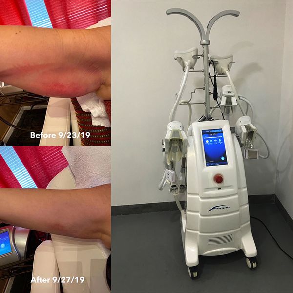 2021 e fat cryolipolysis machine for salon clinic home use fat reducing machine 7 handles weight loss slimming, Black;white
2021 e fat cryolipolysis machine for salon clinic home use fat reducing machine 7 handles weight loss slimming, Black;white