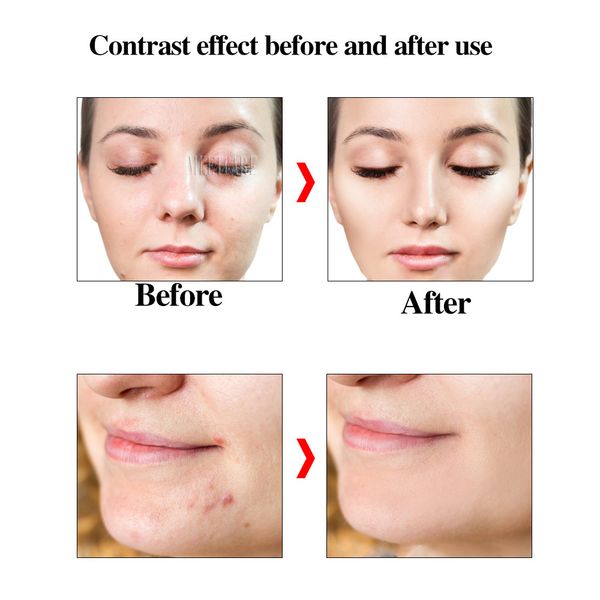 nano microneedle therapy system rf injection mts meso gun face skin care mesogun for skin rejuvenation facial lifting anti aging
nano microneedle therapy system rf injection mts meso gun face skin care mesogun for skin rejuvenation facial lifting anti aging