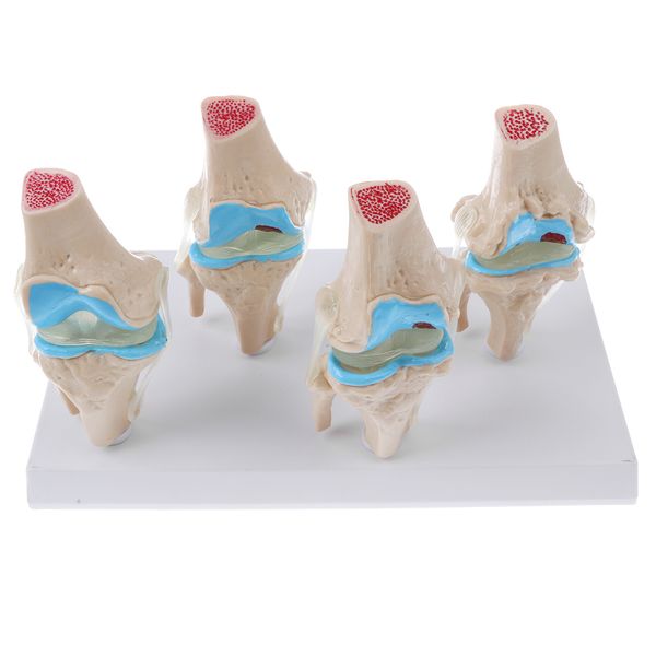 4-stage anatomical human osteoarthritis knee model set, hypertrophic arthritis knee joint disc model, las supplies
4-stage anatomical human osteoarthritis knee model set, hypertrophic arthritis knee joint disc model, las supplies