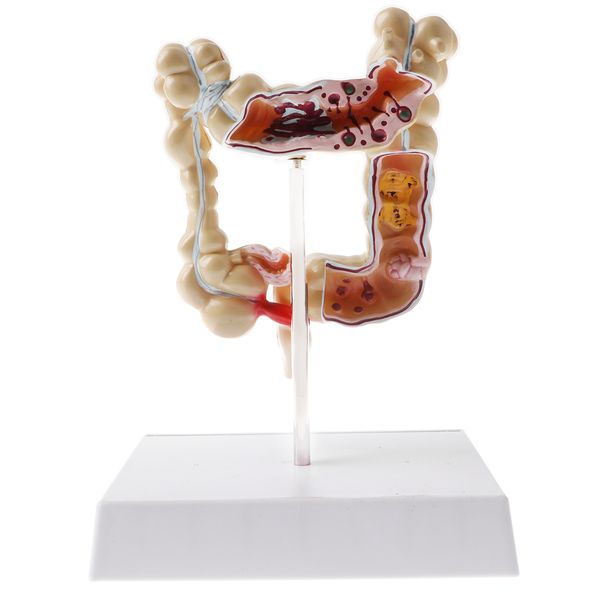 human large intestin pathological model, medical teaching model, 1/2 mini sized, on stand
human large intestin pathological model, medical teaching model, 1/2 mini sized, on stand