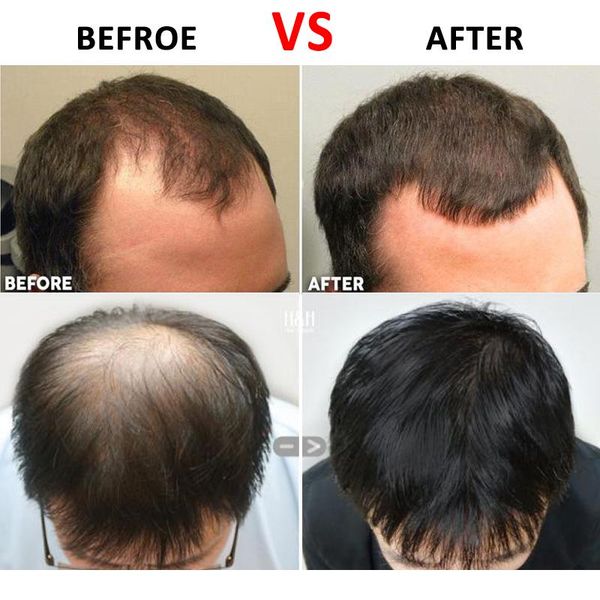 titanium micro needle roller for face and hair regrowth anti hair loss treatment thinning hair/ bald spots / receding wmtema
titanium micro needle roller for face and hair regrowth anti hair loss treatment thinning hair/ bald spots / receding wmtema