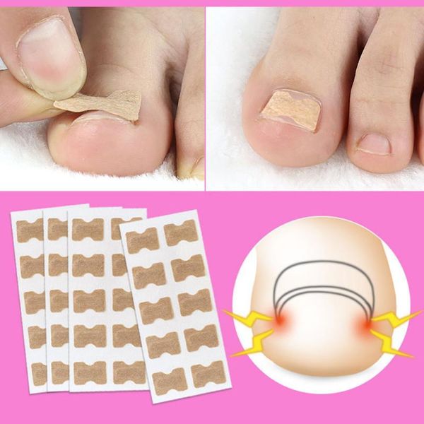 10-50pcs nail sticker toenail toe ingrown correction patch nail art glue tslm1, Black
10-50pcs nail sticker toenail toe ingrown correction patch nail art glue tslm1, Black
