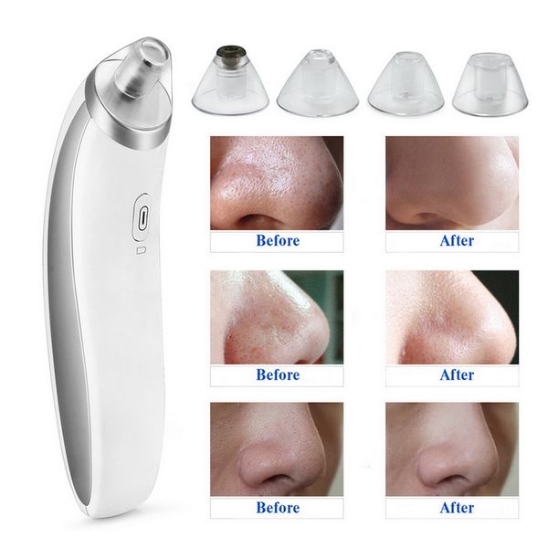 beauty star facial pore cleaner blackhead vacuum suction machine blackhead remover pore cleansing peel with acne removal needle
beauty star facial pore cleaner blackhead vacuum suction machine blackhead remover pore cleansing peel with acne removal needle