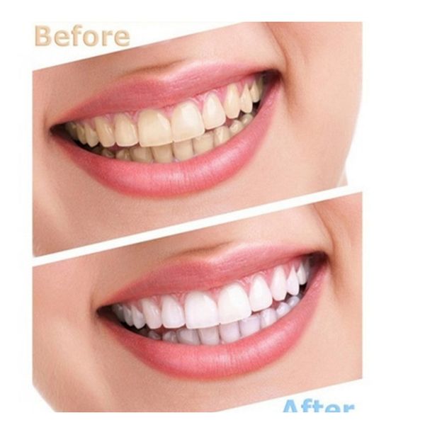 5 pcs safe teeth whitening gel remove stains agent oral hygiene dental care beauty teeth cold light teeth dental material f wmtaum
5 pcs safe teeth whitening gel remove stains agent oral hygiene dental care beauty teeth cold light teeth dental material f wmtaum