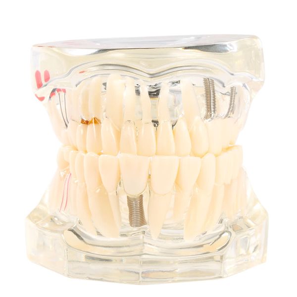 transparent dental implantation disease teeth model teaching teeth tool dental typodont removable teeth model
transparent dental implantation disease teeth model teaching teeth tool dental typodont removable teeth model