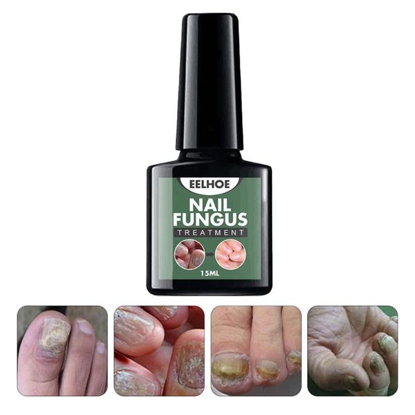 nail gel 2pcs repair liquid treatment toe remove essences, Red;pink