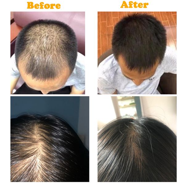 30ml hair growth products fast growing hair oil hair loss care spray beauty & scalp treatment for men womenscouts
30ml hair growth products fast growing hair oil hair loss care spray beauty & scalp treatment for men womenscouts