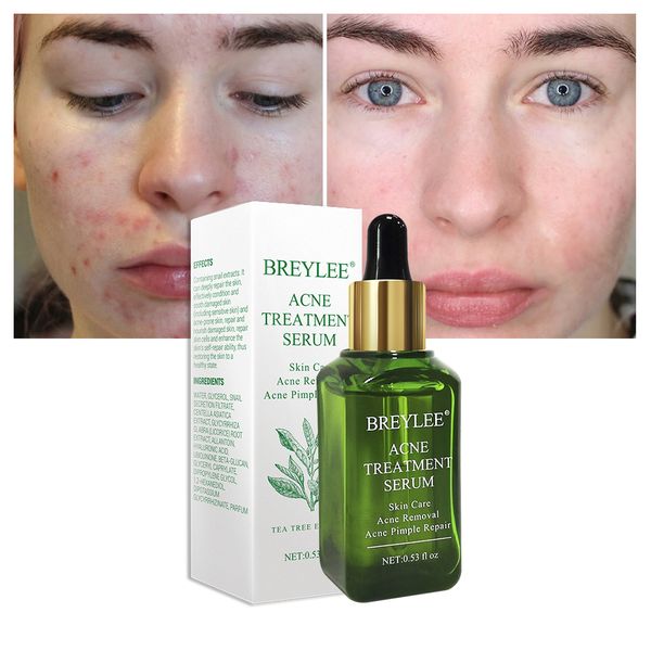 organic tea tree acne treatment serum facial serum face essential oil scar spot pimple removal anti acne repaired for skin care
organic tea tree acne treatment serum facial serum face essential oil scar spot pimple removal anti acne repaired for skin care