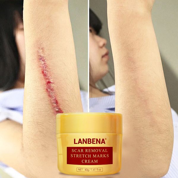 40g scar removal cream maternity stretch removal creams burned skin repaired acne treatment moisturizing facial cream skin care
40g scar removal cream maternity stretch removal creams burned skin repaired acne treatment moisturizing facial cream skin care
