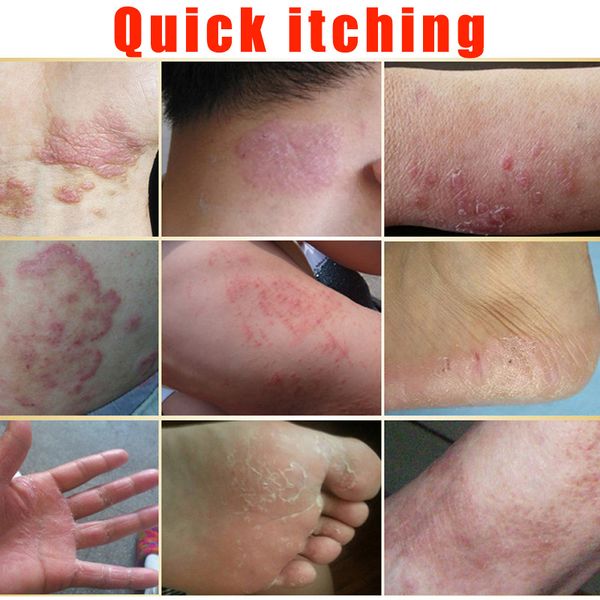 body psoriasis cream perfect for dermatitis and eczema pruritus psoriasis ointment herbal creams tube can csv
body psoriasis cream perfect for dermatitis and eczema pruritus psoriasis ointment herbal creams tube can csv