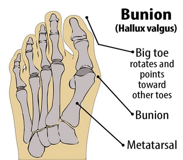 1 pair great toe cyst foot care stretch nylon hallux valgus guard cushion bunion toes separator thumb protector sn
1 pair great toe cyst foot care stretch nylon hallux valgus guard cushion bunion toes separator thumb protector sn