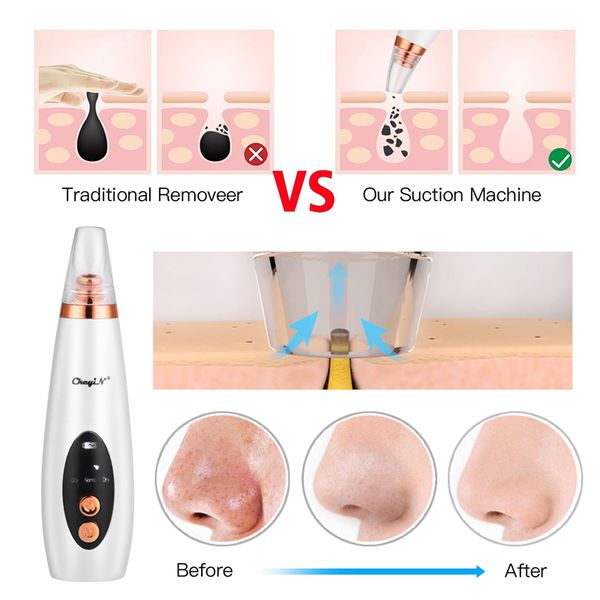 blackhead remover skin care pore vacuum acne pimple removal vacuum suction tool facial diamond dermabrasion machine face clean
blackhead remover skin care pore vacuum acne pimple removal vacuum suction tool facial diamond dermabrasion machine face clean