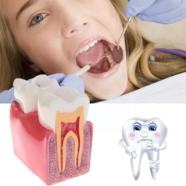 storage bags 1pcs dental teeth model 6 times caries comparation dentistry study product tooth researching denture models and studying de r1h
storage bags 1pcs dental teeth model 6 times caries comparation dentistry study product tooth researching denture models and studying de r1h