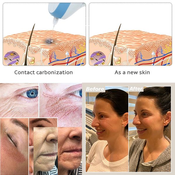 plasma pen home use eyelid lift wrinkle skin lifting tattoo mole removal plasma pen beauty plasma pen medical spot removal perfections
plasma pen home use eyelid lift wrinkle skin lifting tattoo mole removal plasma pen beauty plasma pen medical spot removal perfections