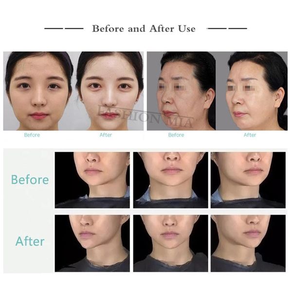 home use no needle radar thread facial collagen thread lift protein peptide for lift anti-wrinkle radar line carve beauty kit perfections
home use no needle radar thread facial collagen thread lift protein peptide for lift anti-wrinkle radar line carve beauty kit perfections