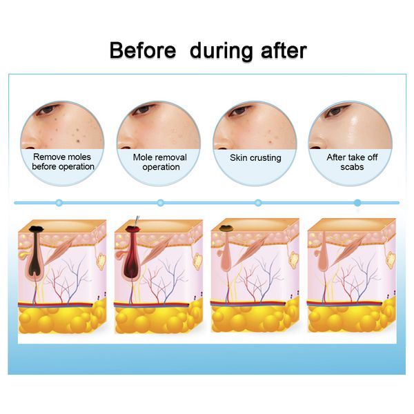 9 level tattoo mole removal machine laser plasma pen dark spot remover lcd skin care point pen skin wart tag beauty carescouts
9 level tattoo mole removal machine laser plasma pen dark spot remover lcd skin care point pen skin wart tag beauty carescouts