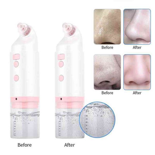 facial bubble vacuum suction with water cycle deep pore cleaning blackhead ance removal oil skin care oxygen facial care tools 220514
facial bubble vacuum suction with water cycle deep pore cleaning blackhead ance removal oil skin care oxygen facial care tools 220514