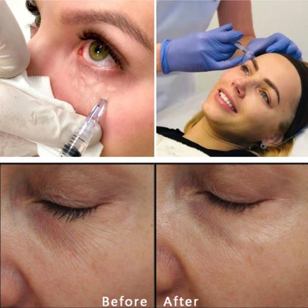 anti aging injection nanosoft microneedle 3pins nano micro injection needle 34g 1.0mm 1.2mm 1.5mm nano microneedling cardridge perfections
anti aging injection nanosoft microneedle 3pins nano micro injection needle 34g 1.0mm 1.2mm 1.5mm nano microneedling cardridge perfections