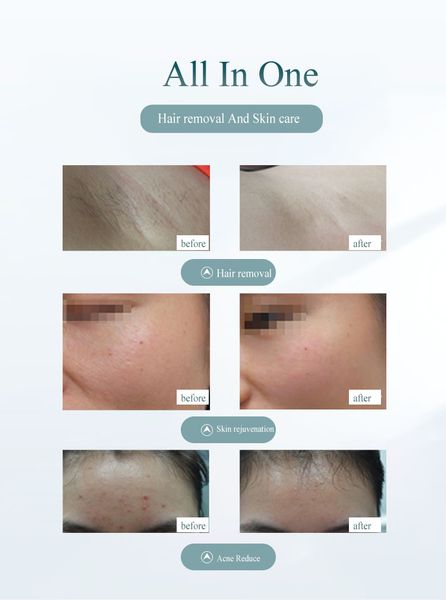 laser epilator painless mini arm female automatic underarm home equipment apparatus perfections
laser epilator painless mini arm female automatic underarm home equipment apparatus perfections