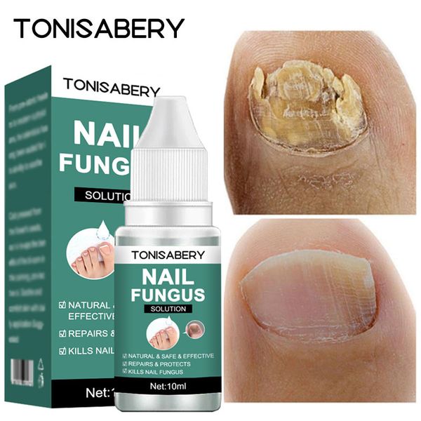 accessories treatment fungal nail feet care essence serum anti infection paronychia onychomycosis foot nail fungus toe removal gel products
accessories treatment fungal nail feet care essence serum anti infection paronychia onychomycosis foot nail fungus toe removal gel products