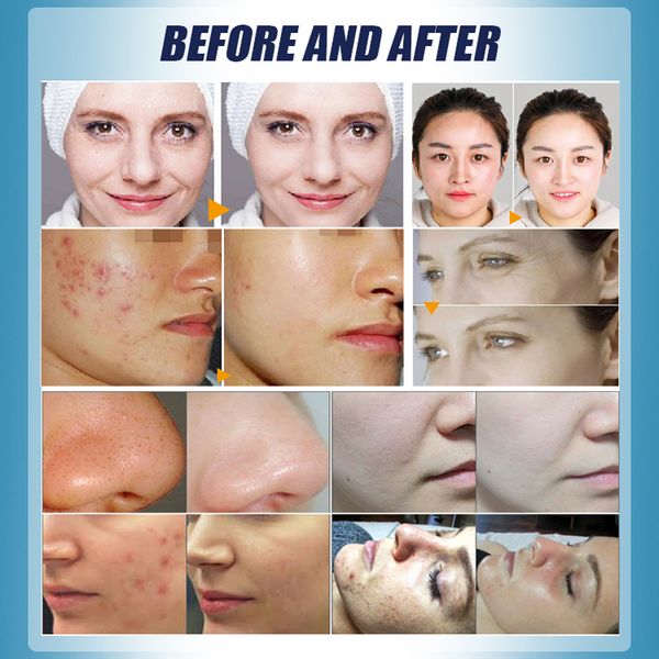 wrinkle smoothing spray gun aqua peel water oxygen jet rf oxygen machine blackhead removal device pore cleaner repair the skin, Black;white
wrinkle smoothing spray gun aqua peel water oxygen jet rf oxygen machine blackhead removal device pore cleaner repair the skin, Black;white