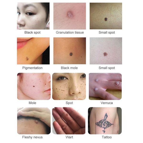 laser plasma spots removal pen removal scars beauty laser mole removal machine tattoo and freckle remove7064464
laser plasma spots removal pen removal scars beauty laser mole removal machine tattoo and freckle remove7064464