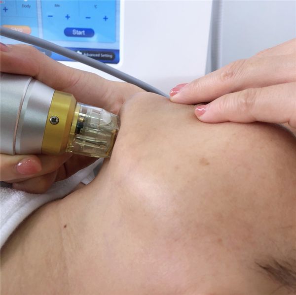 fractional rf scar removal machine microneedle rf ace removal machine radio frequency rf face lifting machine