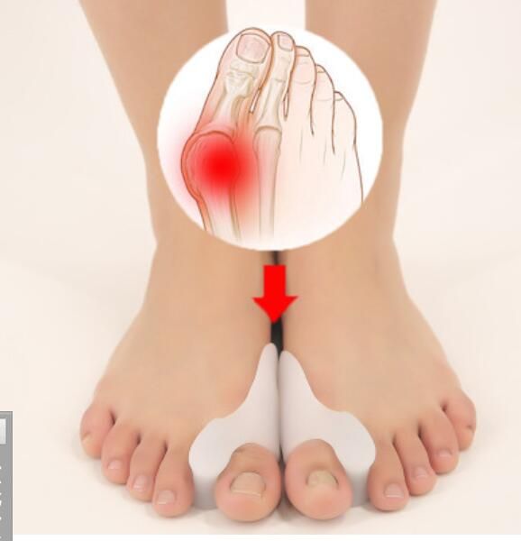 silicone toe separator health care foot treatment hallux valgus orthosis toes valgus corrector
silicone toe separator health care foot treatment hallux valgus orthosis toes valgus corrector