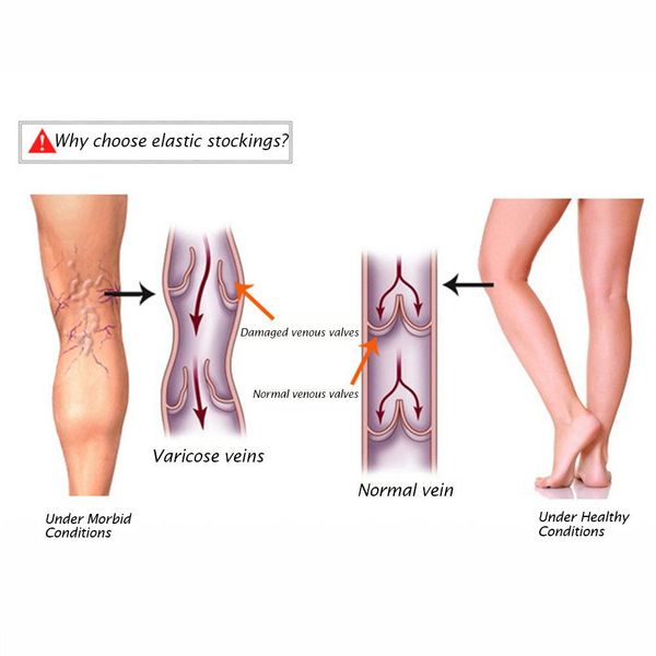 thigh high compression stockings sleeve medical support hose opaque treatment swelling varicose veins edema anti- fatigue socks, Black
thigh high compression stockings sleeve medical support hose opaque treatment swelling varicose veins edema anti- fatigue socks, Black
