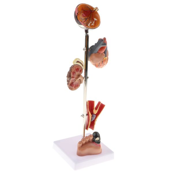 removable 5 parts pathological diabetes 5 parts (eye ball, heart, kidney, vessel, foot) model school teaching display
removable 5 parts pathological diabetes 5 parts (eye ball, heart, kidney, vessel, foot) model school teaching display