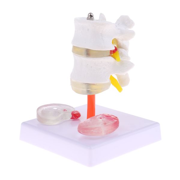 1: 1 life size of highly detailed human lumbar vertebrae with 2 diseased vertebral discs model anatomical learning aids
1: 1 life size of highly detailed human lumbar vertebrae with 2 diseased vertebral discs model anatomical learning aids