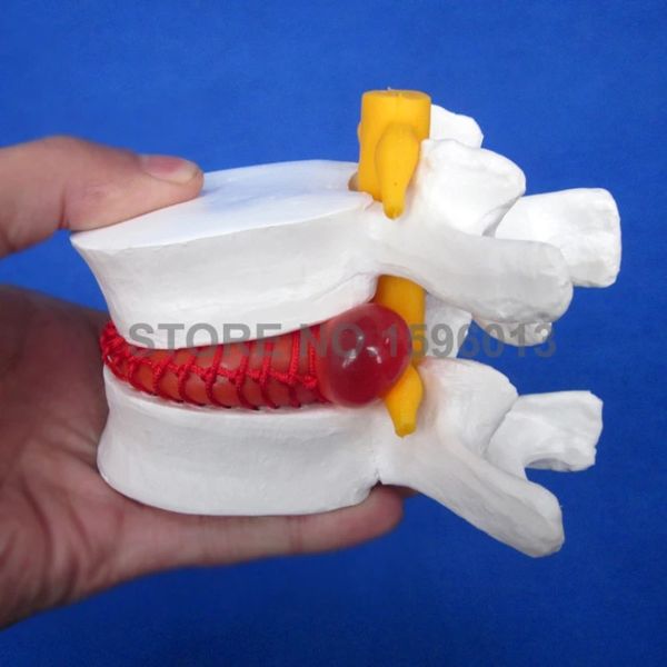 Amplified Lumbar Vertebra Model Herniated Disc Simulator — compare prices at CompareOffers