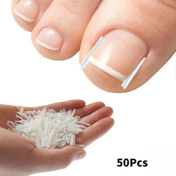 50Pcs Toenail Correction Ingrown Toe Nail Treatment Elastic Patch Sticker Straightening Clip Brace Pedicure Tool ddmynov