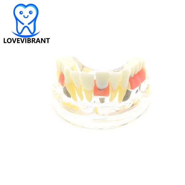 Dental Teeth Model Transparent Dental Caries Implant Dentistry Teaching Model With 3-unit Removable Bridge Dental Products