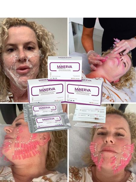 korea minerva fishbone molding barbs cog mono screw for face fox eye neck nose lift pdo thread
korea minerva fishbone molding barbs cog mono screw for face fox eye neck nose lift pdo thread