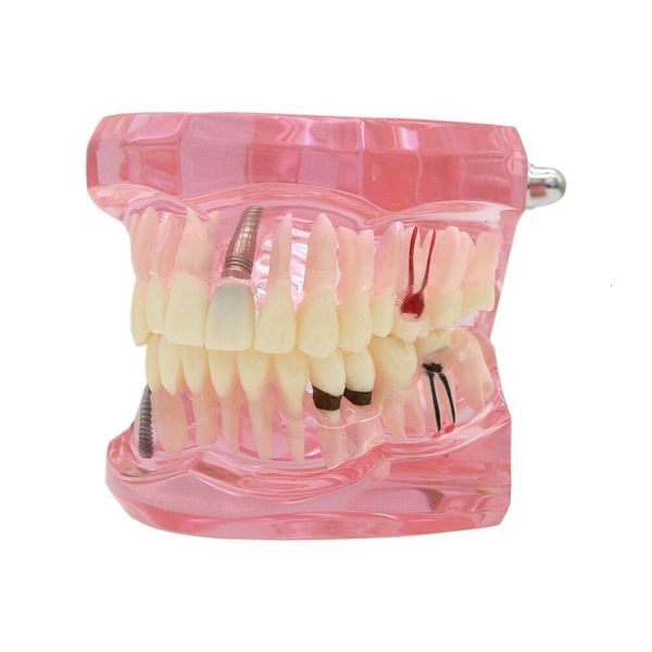 dental floss implant teeth model teach study demo restoration pathology bridge m2001 230321
dental floss implant teeth model teach study demo restoration pathology bridge m2001 230321