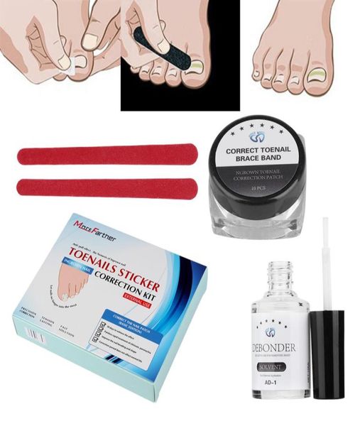 1set 10pcs elastic ingrown toe nail pedicure patch straightening clip brace with glue pedicure tools toenail correction tool set9369399
1set 10pcs elastic ingrown toe nail pedicure patch straightening clip brace with glue pedicure tools toenail correction tool set9369399