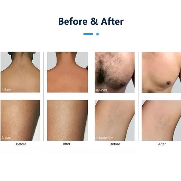 dresses portable 2000w beauty equipment ice device 808 755 1064 nm diode laser hair removal hine price, Black;gray
dresses portable 2000w beauty equipment ice device 808 755 1064 nm diode laser hair removal hine price, Black;gray