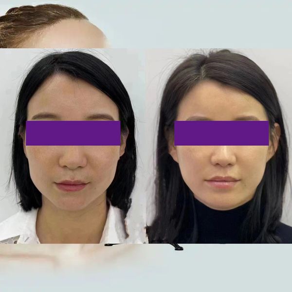 wrinkle removal rejuvenating skin to reduce wrinkles professional anti-wrinkle products facial beauty anti-wrinkle lifting and firming face
wrinkle removal rejuvenating skin to reduce wrinkles professional anti-wrinkle products facial beauty anti-wrinkle lifting and firming face