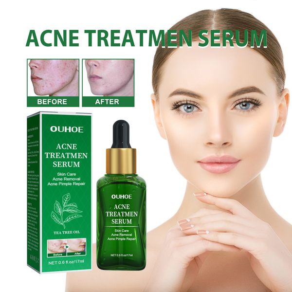17ml anti acne facial essence solution for removing lightening acne marks controlling oil repairing shrinking pores serum
17ml anti acne facial essence solution for removing lightening acne marks controlling oil repairing shrinking pores serum