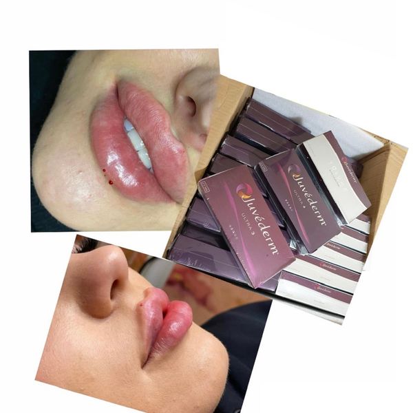 beauty items crosslinked juvderms nose lip hyaluronics ha filler 
beauty items crosslinked juvderms nose lip hyaluronics ha filler