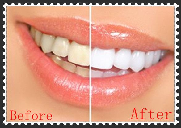:. How Does Teeth Whitening Work At The Dentist For Sale 