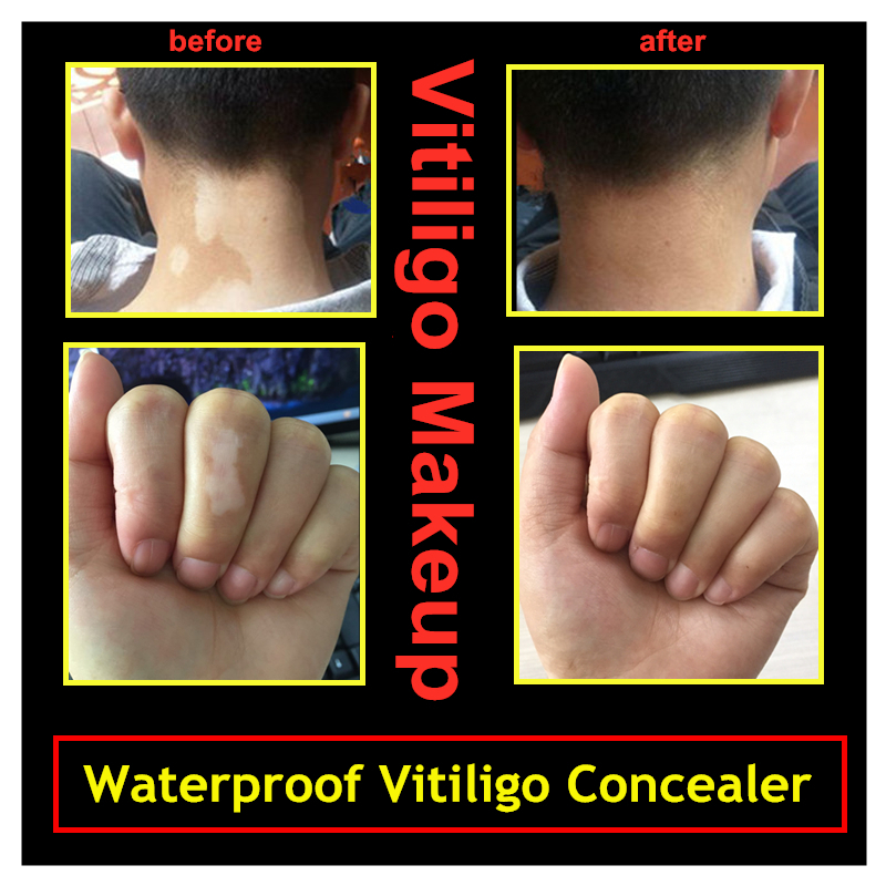 Vitiligo Concealer Covering Liquid Pen Waterproof Vitiligo White Spots Long-Lasting Leukoderma Instant Makeup for Skin Discolored 2pcs 2689
Vitiligo Concealer Covering Liquid Pen Waterproof Vitiligo White Spots Long-Lasting Leukoderma Instant Makeup for Skin Discolored 2pcs 2689